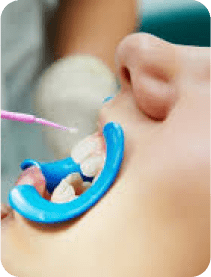 Vernis fluoré chez l’enfant : application professionnelle de fluor pour renforcer l’émail, prévenir les caries et protéger durablement les dents de lait et permanentes.