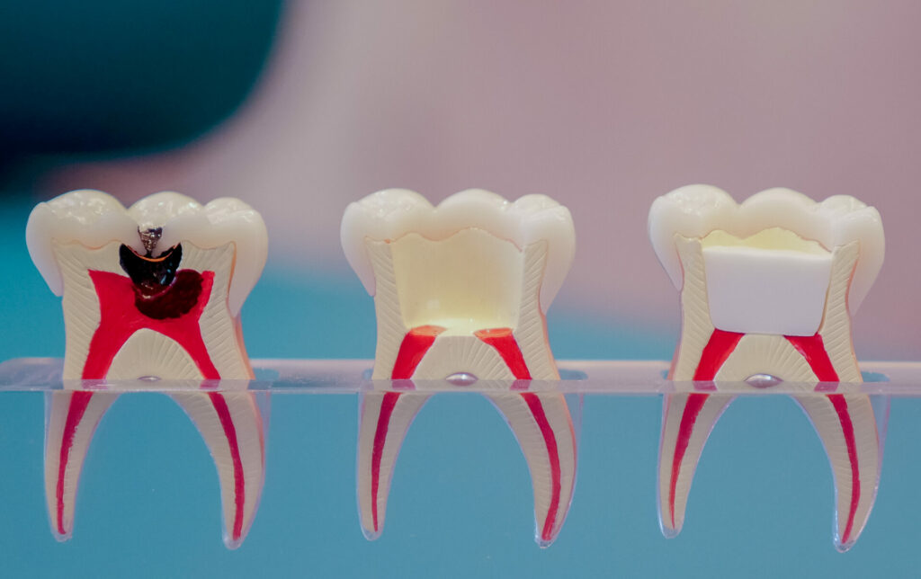 Pulpotomie : traitement dentaire chez l’enfant pour soigner une dent de lait cariée Pulpotomie : traitement dentaire chez l’enfant pour soigner une dent de lait cariée en retirant la partie infectée du nerf tout en préservant la pulpe saine dans les racines.