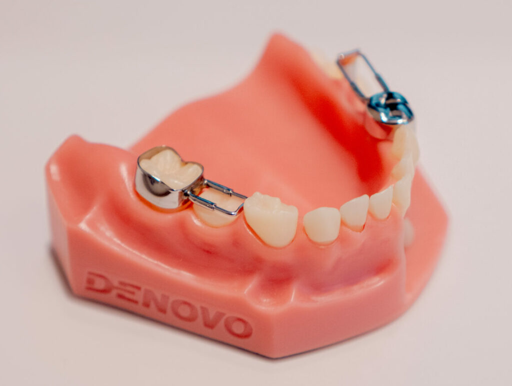 Mainteneur d’espace : appareil dentaire chez l’enfant, en métal ou avec dent en résine, destiné à garder la place pour les dents définitives après la perte d’une dent de lait.