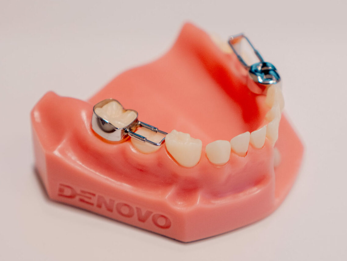 Mainteneur d’espace : appareil dentaire chez l’enfant, en métal ou avec dent en résine, destiné à garder la place pour les dents définitives après la perte d’une dent de lait.