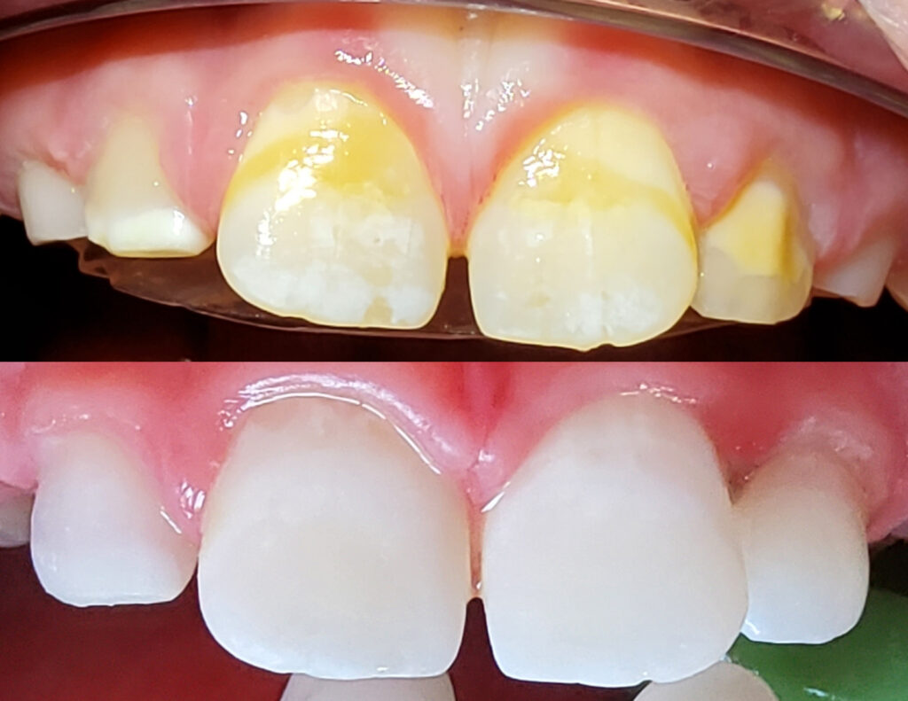 Érosion / infiltration résineuse Icon : traitement esthétique chez l’enfant pour corriger les taches blanches ou jaunâtres de l’émail sans anesthésie, grâce à une résine infiltrante non invasive.
