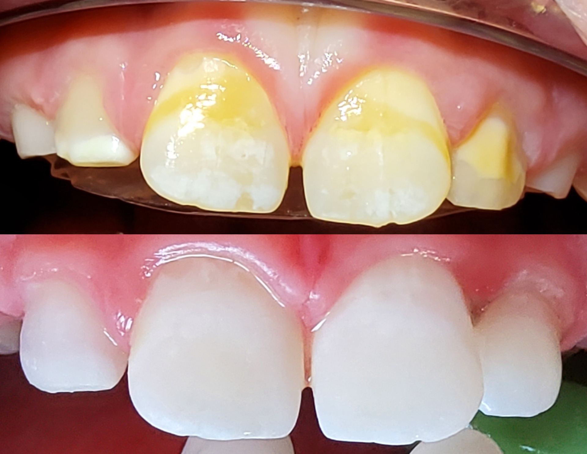 Érosion / infiltration résineuse Icon : traitement esthétique chez l’enfant pour corriger les taches blanches ou jaunâtres de l’émail sans anesthésie, grâce à une résine infiltrante non invasive.