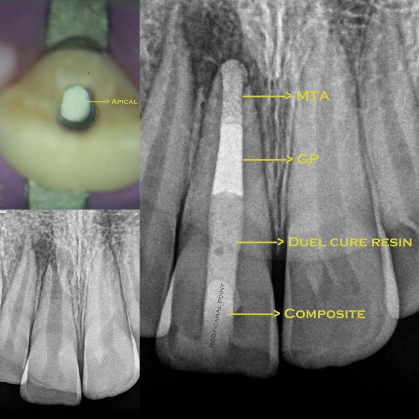 Apexification : traitement dentaire chez l’enfant pour aider la racine d’une dent à se refermer grâce à un biomatériau après la nécrose du nerf.