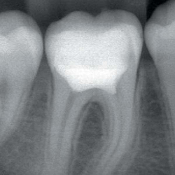 Apexogenèse chez l’enfant : traitement dentaire visant à préserver le nerf sain d’une dent permanente immature et à favoriser la maturation naturelle des racines grâce à un biomatériau, avec suivi régulier.