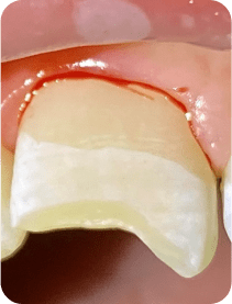 raumatisme dentaire chez l’enfant : conseils après un choc sur les dents, soins à suivre, précautions alimentaires et démarches administratives pour la prise en charge par l’assurance.