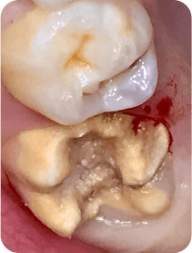 MIH – hypominéralisation des molaires et incisives chez l’enfant : défaut de formation de l’émail provoquant des taches blanches, jaunes ou brunes sur les dents permanentes, souvent lié à des facteurs environnementaux ou médicaux précoces.