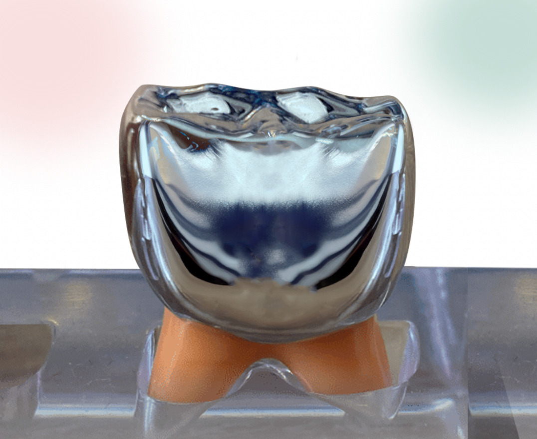 Coiffe pédodontique préformée (CPP) : couronne dentaire chez l’enfant utilisée pour protéger et restaurer une dent de lait abîmée ou cariée.