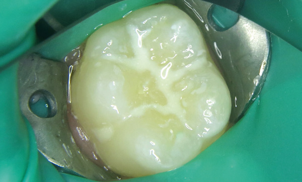 Scellement des sillons : soin préventif chez l’enfant consistant à protéger les sillons des dents avec une résine pour éviter les caries.